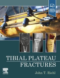 Tibial Plateau Fractures