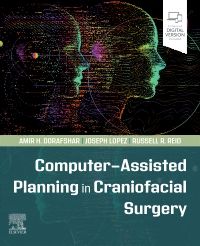 Computer-Assisted Planning in Craniofacial Surgery