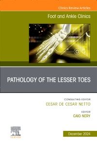 Pathology of the Lesser Toes, An issue of Foot and Ankle Clinics of North America